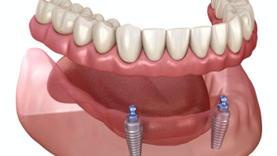 Implant-Supported Dentures