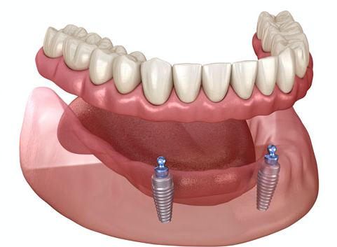 Implant-Supported Dentures