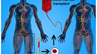 Bone-Marrow-Transplantation