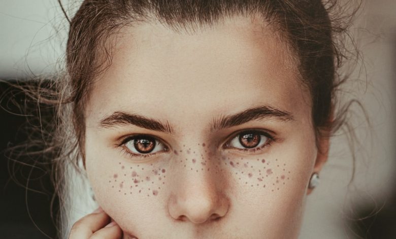 face Freckle