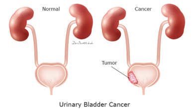 Urinary Bladder Cancer