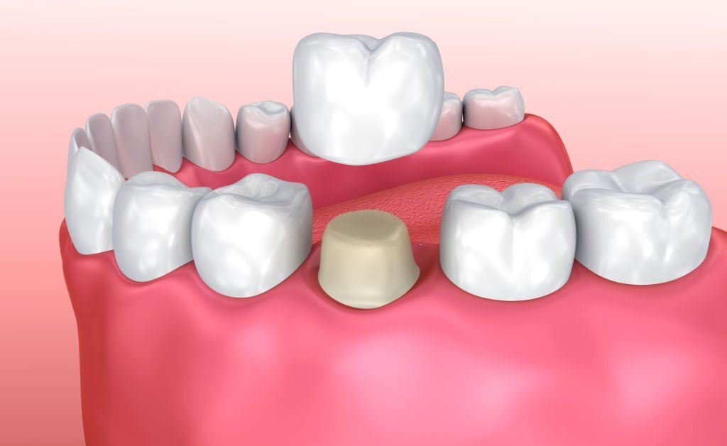 Dental crown