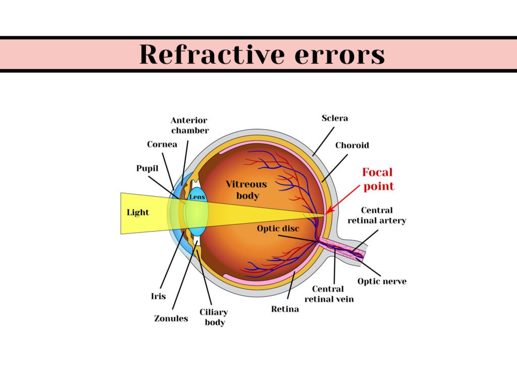 Refractive Errors - Featured Image